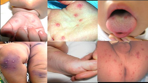 Dấu hiệu và triệu chứng bệnh tay chân miệng ở trẻ em