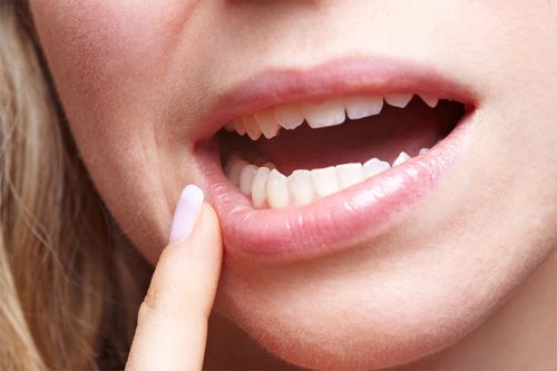 Cách làm răng chắc khỏe khi bị lung lay tại nhà